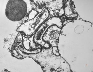M,50y. | Pneumocystis carinii M,50y. | Pneumocystis carinii